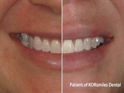 KORsmiles Dental | Snoring Appliances, Perio Protect and Root Canals